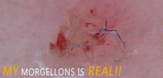 morgellons_top_image